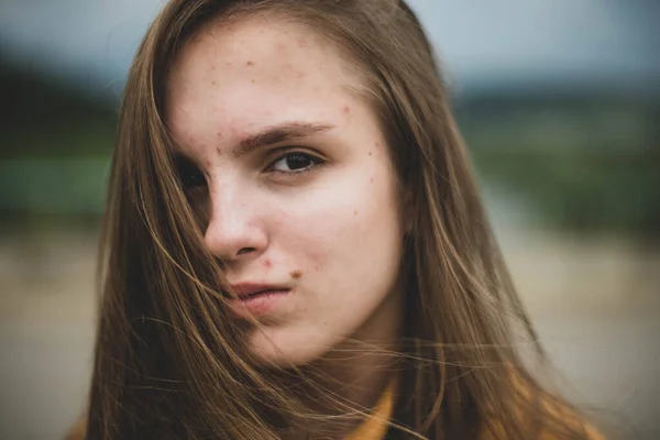 Retrato Jovem Bela Mulher Adolescente Bonito Com Franjas Pele Problemática — Fotografia de Stock