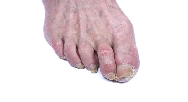 Yaya Olarak Hasta Tırnaklar Ayak Tırnağı Mantarı Beyazda Izole Edilmiş — Stok fotoğraf