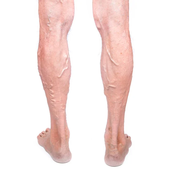 Нога Пожилого Мужчины Варикозным Расширением Вен Изолирована Белом Фоне Варикоз — стоковое фото