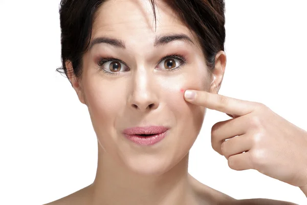 Beautiful young woman showing a pimple on her face — Stock Photo, Image