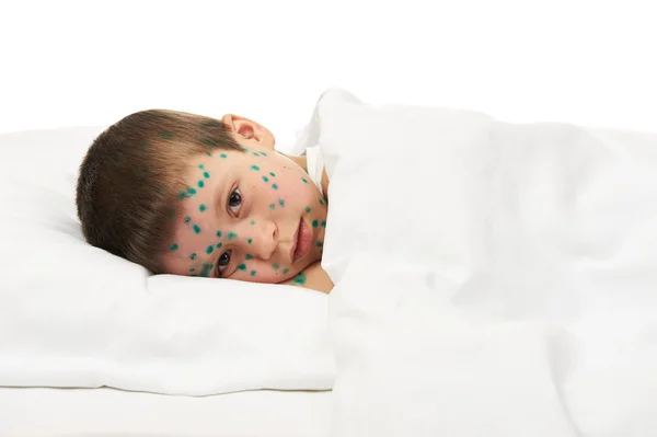 Sick child has the virus on skin — Stock Photo, Image