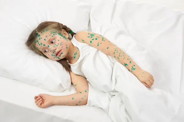 Sick child has the virus on skin — Stock Photo, Image