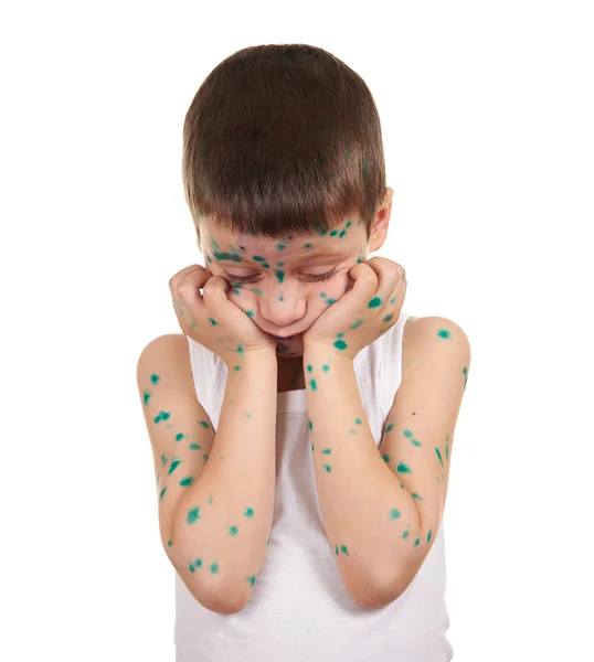 Niño enfermo tiene el virus en la piel — Foto de Stock