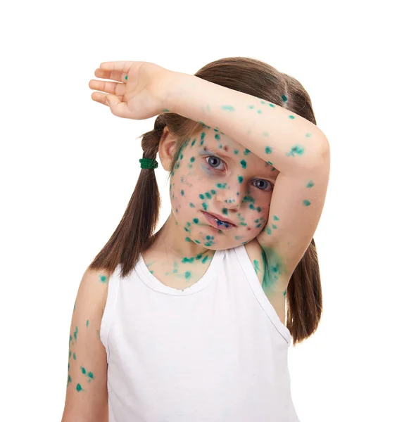 Criança doente tem o vírus na pele — Fotografia de Stock