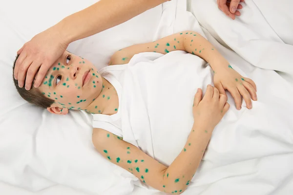 Sick child in bed has the virus on skin — Stock Photo, Image