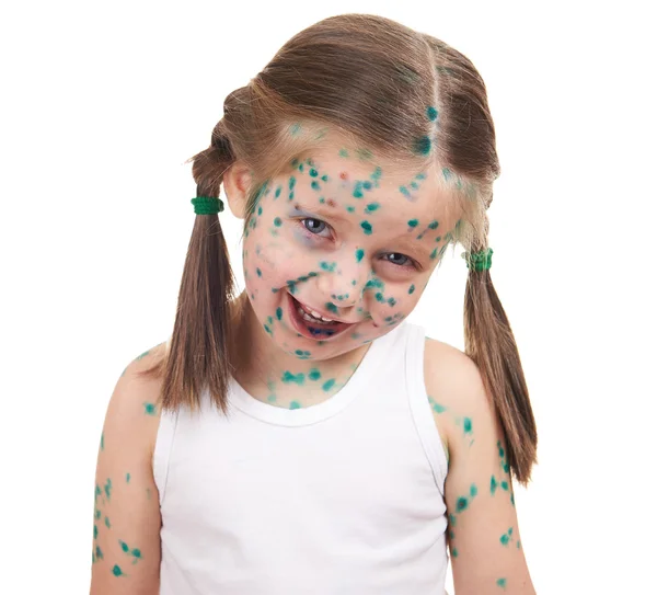 Il bambino ha il virus su pelle — Foto Stock