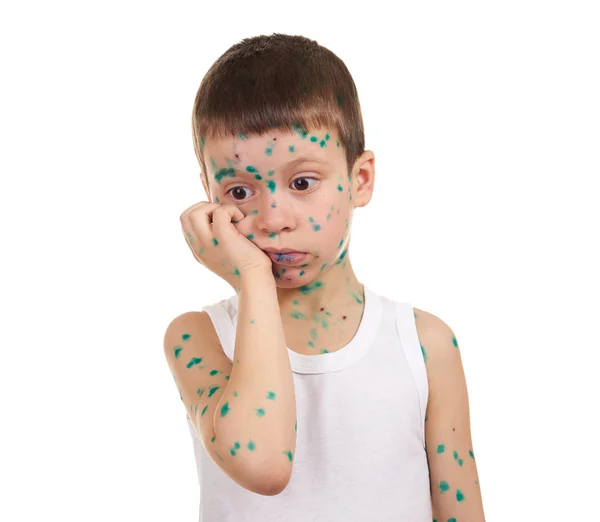 Child has the virus on skin — Stock Photo, Image