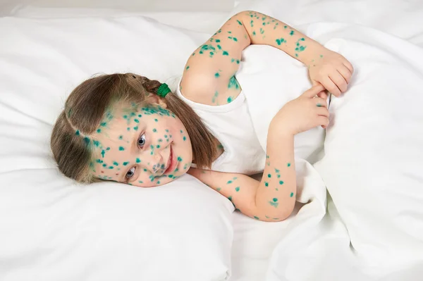 Child has the virus on skin — Stock Photo, Image