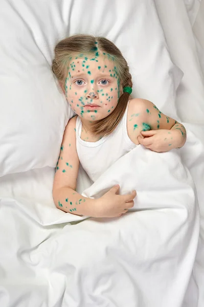 Dziecko ma wirusa na skórze — Zdjęcie stockowe