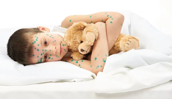 Child has the virus on skin — Stock Photo, Image