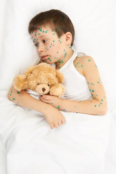 Child has the virus on skin — Stock Photo, Image