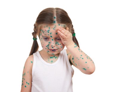 child has the virus on skin clipart