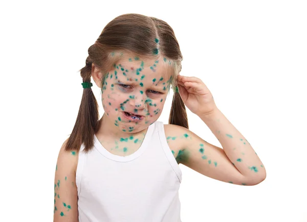 Child has the virus on skin — Stock Photo, Image