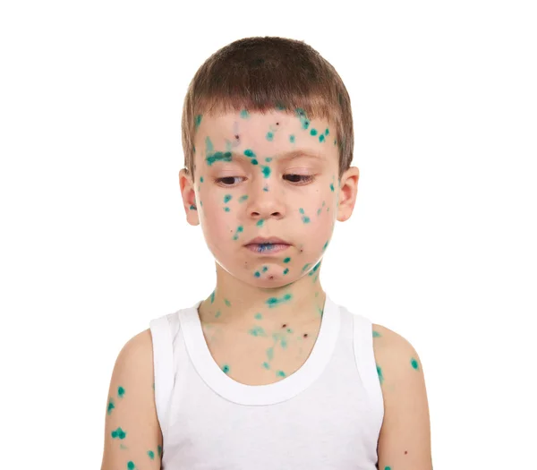 Child has the virus on skin — Stock Photo, Image