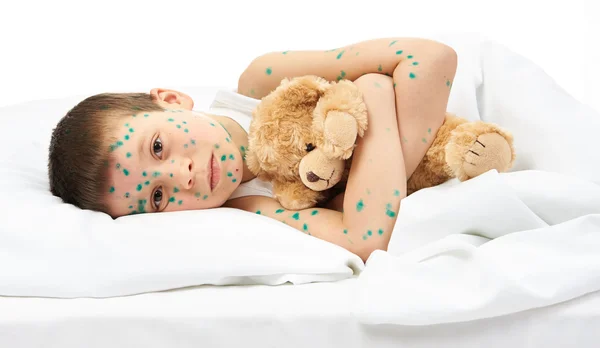 Child has the virus on skin — Stock Photo, Image