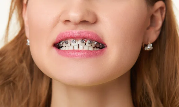 Aparaty na zęby, piękna kobieta twarz uśmiech z bliska. — Zdjęcie stockowe