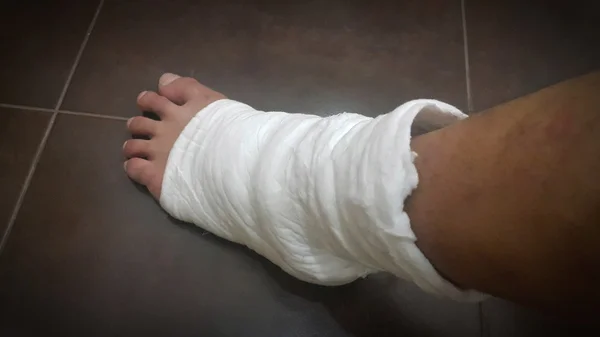 Μαλακό νάρθηκας να θεραπεύσει τραυματισμού στο πόδι — Φωτογραφία Αρχείου
