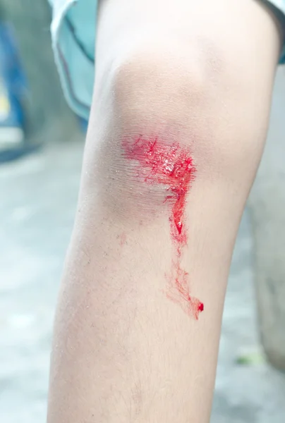 Sangrado raspado rodilla humana después de caer de la bicicleta — Foto de Stock