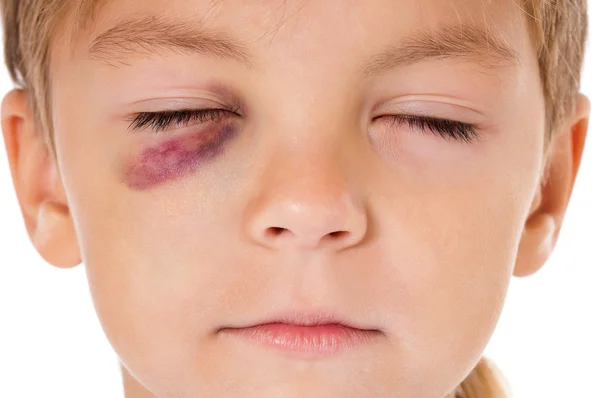 Boy with bruise — Stock Photo, Image