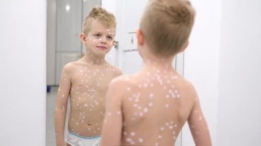 Küçük Çocuk aynada kendini muayene ediyor. Varicella virüsü veya çocuk üzerinde suçiçeği kabarcığı kızarıklığı. Derisine merhem sürmüş, gülen çocuk.