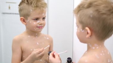 Küçük çocuk cildine beyaz antiseptik krem sürüyor. Varicella virüsü ya da çocuk üzerinde suçiçeği kabarcıkları.