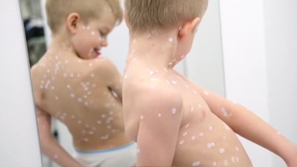 Little Boy onderzoekt zichzelf in de spiegel. Varicella virus of waterpokken zeepbel uitslag op kind. Vrolijk lachend kind met zalf op de huid — Stockvideo