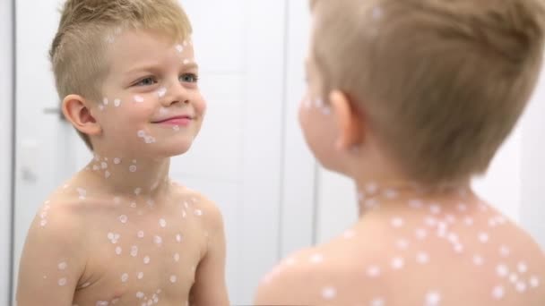Little Boy onderzoekt zichzelf in de spiegel. Varicella virus of waterpokken zeepbel huiduitslag bij kind. — Stockvideo