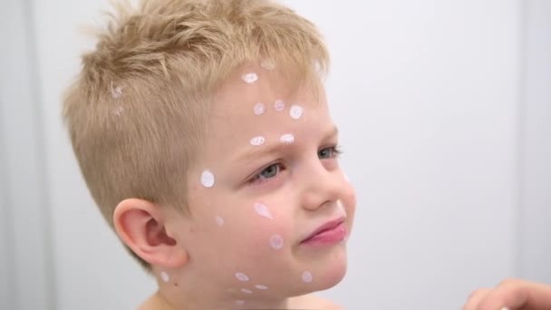 Moeder die ontsmettende crème op de huid van de zoon aanbrengt. Varicella virus of waterpokken zeepbel huiduitslag bij kind. — Stockvideo