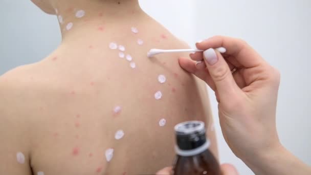 Madre aplicando crema antiséptica sobre la piel del hijo. Virus de la varicela o erupción por burbuja de varicela en el niño. — Vídeos de Stock