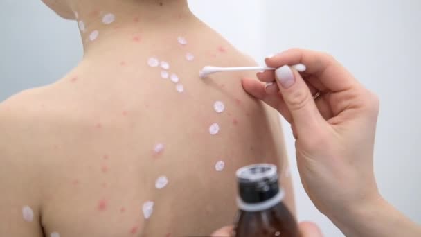 Mãe aplicando creme anti-séptico na pele do filho. Varicela vírus ou varicela erupção cutânea bolha na criança. — Vídeo de Stock