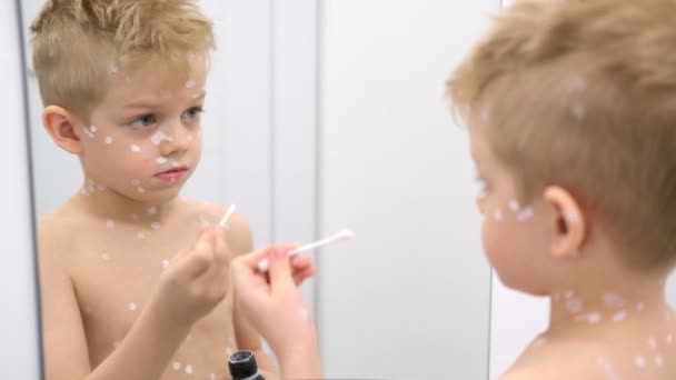 Kleine jongen die witte ontsmettende crème op de huid aanbrengt. Varicella virus of waterpokken zeepbel huiduitslag bij kind. — Stockvideo