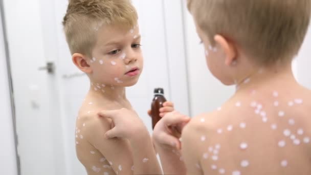 Малыш рассматривает себя в зеркале. Вирус варицеллы или сыпь от ветрянки на ребенке. — стоковое видео