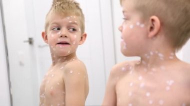 Küçük Çocuk aynada kendini muayene ediyor. Varicella virüsü veya çocuk üzerinde suçiçeği kabarcığı kızarıklığı. Derisine merhem sürmüş, gülen çocuk.