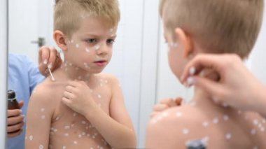 Anne, oğlunun derisine antiseptik krem sürüyor. Varicella virüsü ya da çocuk üzerinde suçiçeği kabarcıkları.