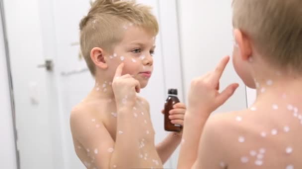 Little Boy onderzoekt zichzelf in de spiegel. Varicella virus of waterpokken zeepbel uitslag op kind. Vrolijk lachend kind met zalf op de huid — Stockvideo