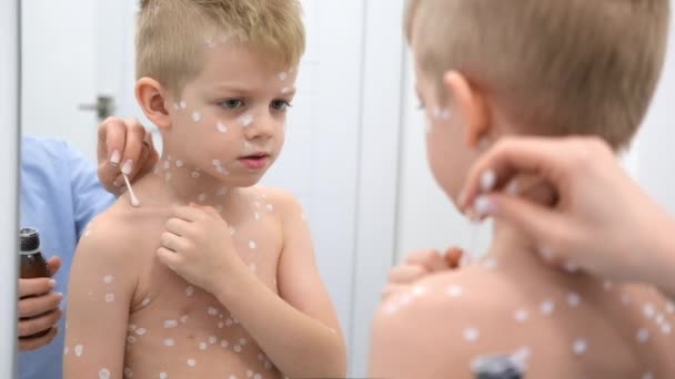 Mãe aplicando creme anti-séptico na pele do filho. Varicela vírus ou varicela erupção cutânea bolha na criança. — Vídeo de Stock