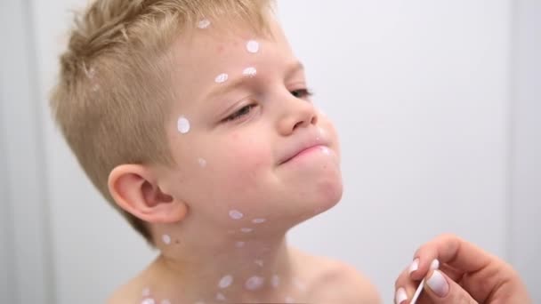 Moeder die ontsmettende crème op de huid van de zoon aanbrengt. Varicella virus of waterpokken zeepbel huiduitslag bij kind. — Stockvideo