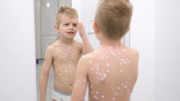 Little Boy onderzoekt zichzelf in de spiegel. Varicella virus of waterpokken zeepbel huiduitslag bij kind. — Stockvideo