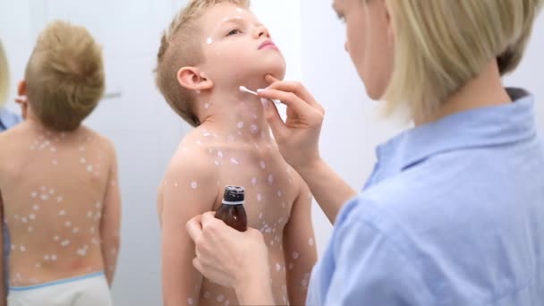 Moeder die ontsmettende crème op de huid van haar zoon aanbrengt. Varicella virus of waterpokken zeepbel huiduitslag bij kind. — Stockvideo