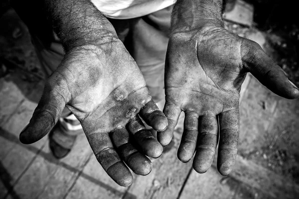 Açık avuç içi yaralı