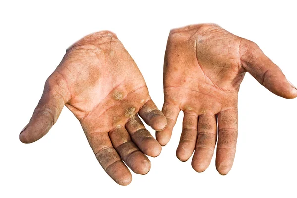 Açık avuç içi yaralı