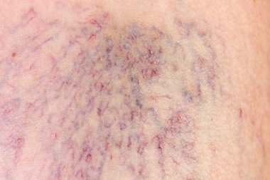 DermIS ile varis Close-Up