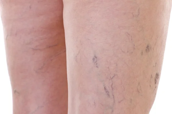 Gros plan des jambes avec varices — Photo