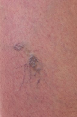 Varisli damarlar ile cilt Close-Up