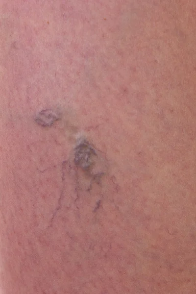 Close-up van huid met spataderen — Stockfoto