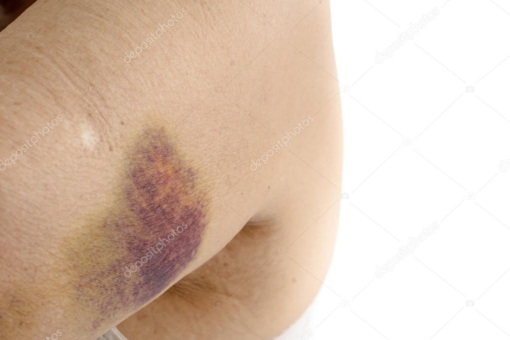 Gran moretón en el brazo Moretones por inyección — Foto