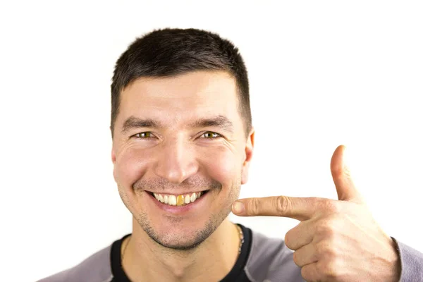 Yellow Damaged Tooth Smiling Caucasian Man Close Focus Teeth Dental — Stock Photo, Image