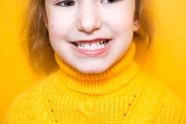 Kız dişlerini gösteriyor. Patolojik ısırık, malocclusion, overbite. Pediatrik dişçilik ve periodontikler, ısırık düzeltmesi. Sağlık ve diş bakımı, bakımı, bebek dişleri. Üst çene sakıza dayanır.