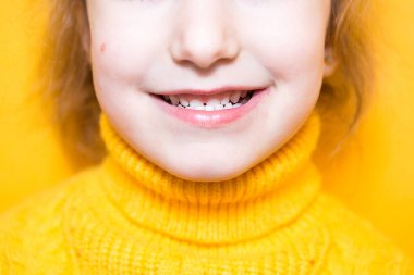 Kız dişlerini gösteriyor. Patolojik ısırık, malocclusion, overbite. Pediatrik dişçilik ve periodontikler, ısırık düzeltmesi. Sağlık ve diş bakımı, bakımı, bebek dişleri. Üst çene sakıza dayanır.