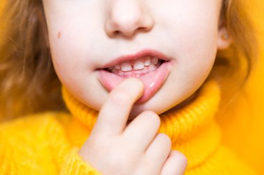 Kız dişlerini gösteriyor. Patolojik ısırık, malocclusion, overbite. Pediatrik dişçilik ve periodontikler, ısırık düzeltmesi. Sağlık ve diş bakımı, bakımı, bebek dişleri. Üst çene sakıza dayanır.